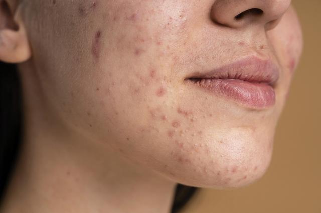 أسباب وعوارض حساسية البشرة وطرق علاجها طبيعياً