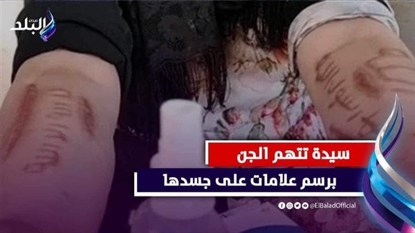 ظهرت فجأة.. جروح تكتب لفظ الجلالة و«الشهادتين» على جسد سيدة في الغربية
