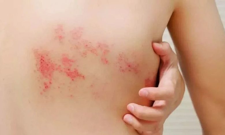 مرض الحزام الناري وعوامل خطورة الإصابة به