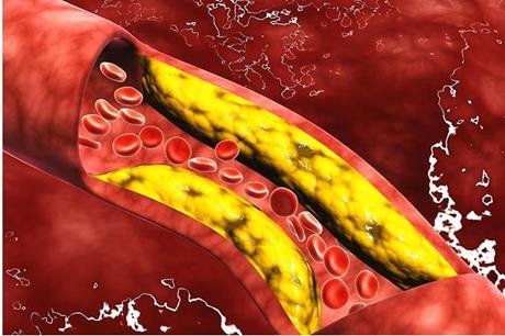 ارتفاع الضغط والكوليسترول يضاعف الخطر على القلب