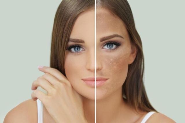 تعرفي على أسباب اسمرار البشرة فجأة.. ونصائح لتجنبه