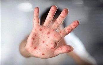 الصحة العالمية: جدري القردة لا يزال يمثل حالة طوارئ صحية عامة