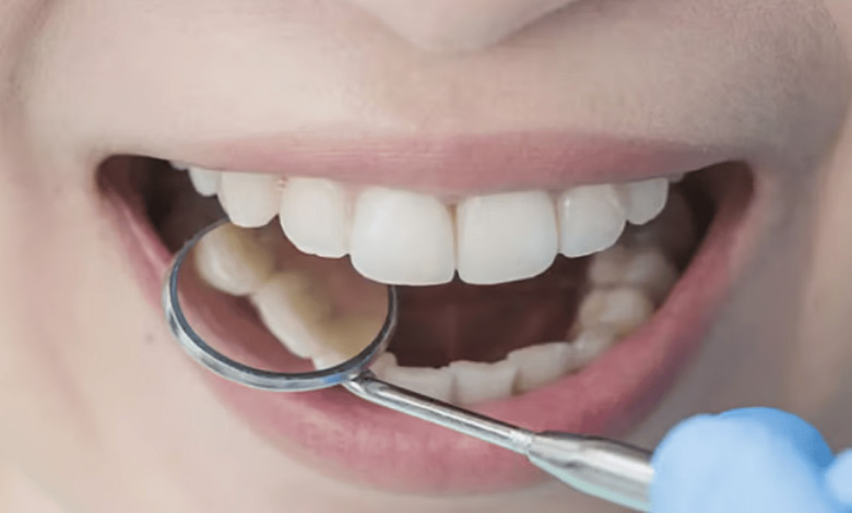 5 أسباب وراء تسوس الأسنان
