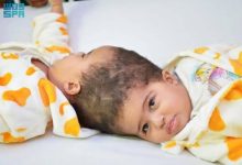 نجاح فصل التوأم الملتصق الإريتري «أسماء وسمية» بعد عملية استغرقت أكثر من 15 ساعة - أخبار السعودية