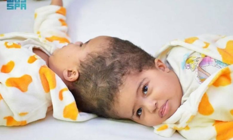 نجاح فصل التوأم الملتصق الإريتري «أسماء وسمية» بعد عملية استغرقت أكثر من 15 ساعة - أخبار السعودية