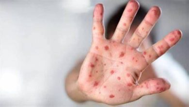 أزمة صحية في تكساس.. الحصبة تنتشر في دالاس وتثير الذعر بين السكان - أخبار السعودية
