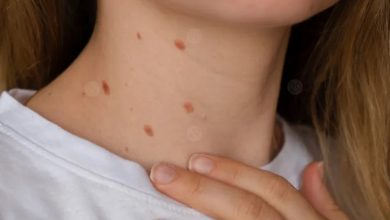 وصفة شعبية مجربة لإزالة الثآليل