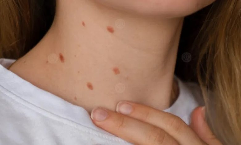 وصفة شعبية مجربة لإزالة الثآليل