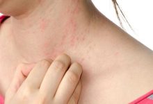 أمراض الجلد في الصيف.. عندما يتحول الحر والرطوبة إلى تهديد لصحة البشرة