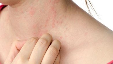 أمراض الجلد في الصيف.. عندما يتحول الحر والرطوبة إلى تهديد لصحة البشرة