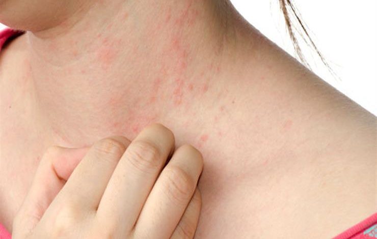 أمراض الجلد في الصيف.. عندما يتحول الحر والرطوبة إلى تهديد لصحة البشرة