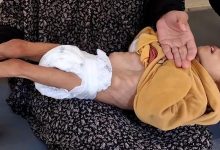 حالتا وفاة جديدتان نتيجة المجاعة وسوء التغذية في غزة