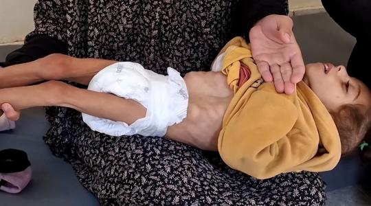 حالتا وفاة جديدتان نتيجة المجاعة وسوء التغذية في غزة