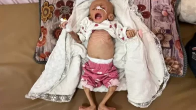 شهيد الجوع الثاني خلال 24 ساعة في قطاع غزة