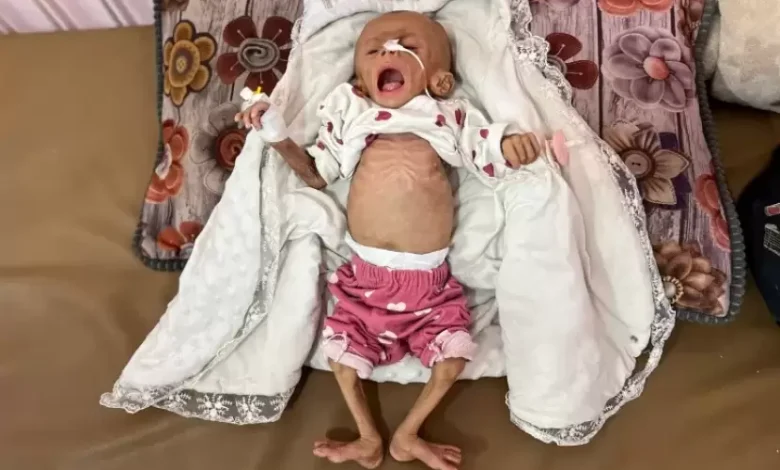 شهيد الجوع الثاني خلال 24 ساعة في قطاع غزة