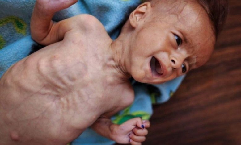 8 وفيات بينهم طفل نتيجة المجاعة بغزة خلال الـ24 ساعة الماضية