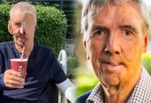 بعد حادث مروع.. بريطاني يحصل على أول وجه مطبوع بتقنية ثلاثية الأبعاد
