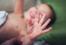 مرض اليد والقدم والفم.. كيف يمكن الوقاية من عدوى HFMD الشائعة بين الأطفال؟