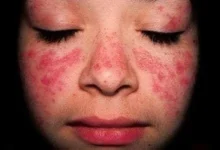 كيف خدعت الذئبة الجلدية الجميع وظهرت كحبّ شباب عادي؟