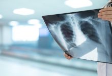 تجربة سريرية تعلن عن دواء جديد لمكافحة السل المقاوم...