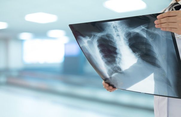 تجربة سريرية تعلن عن دواء جديد لمكافحة السل المقاوم...