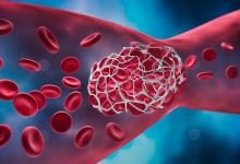 علماء يبتكرون جسيمات نانوية آمنة تمنع الجلطات الدموية