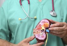 ابتكار أداة مدعومة بالذكاء الاصطناعي للكشف المبكر عن سرطان الكلى