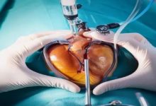 استشارة طبية: مضاعفات نادرة لقسطرة القلب