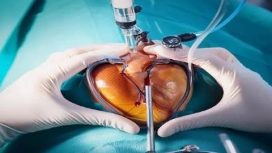 استشارة طبية: مضاعفات نادرة لقسطرة القلب