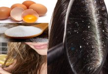 التخلص من قشرة الشعر بالبيض بوصفة طبيعية وغير مكلفة في أقل من أسبوع