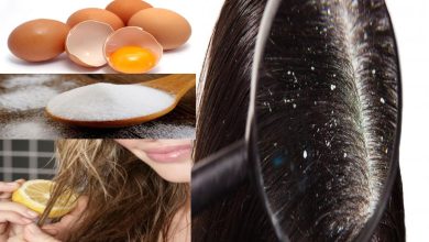 التخلص من قشرة الشعر بالبيض بوصفة طبيعية وغير مكلفة في أقل من أسبوع
