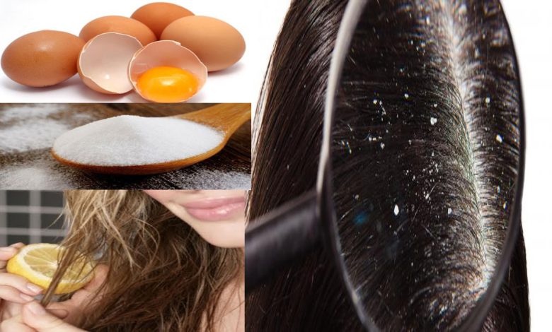 التخلص من قشرة الشعر بالبيض بوصفة طبيعية وغير مكلفة في أقل من أسبوع