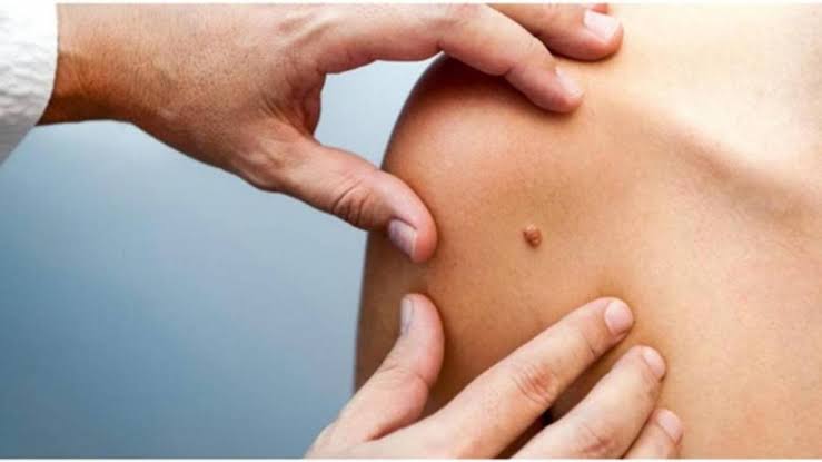 باحثون: جرعة واحدة من لقاح الورم الحليمي تكفي للوقاية من السرطان