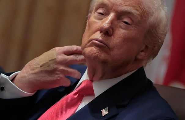 ترامب يظهر مرة أخرى بضمادة على معصمه...