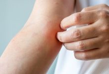 نصائح فعالة للسيطرة على الإكزيما وتجنب نوبات التهيج