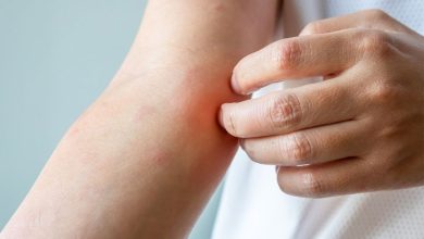 نصائح فعالة للسيطرة على الإكزيما وتجنب نوبات التهيج