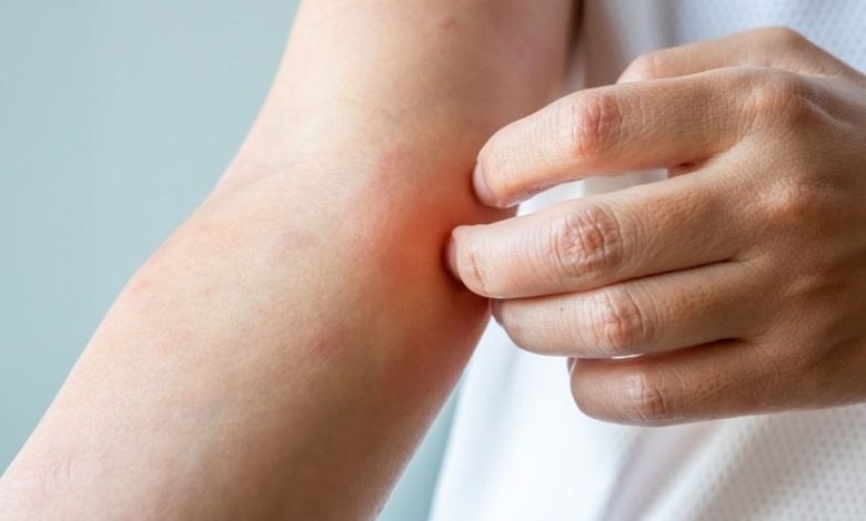 نصائح فعالة للسيطرة على الإكزيما وتجنب نوبات التهيج