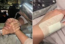 الصحة تُحذر من «ترند المياه المغلية»: سلوكيات غير آمنة تؤدي لمضاعفات خطيرة