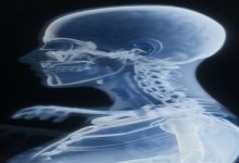 دراسة أميركية تكشف أملاً جديداً لمرضى سرطان الرئة