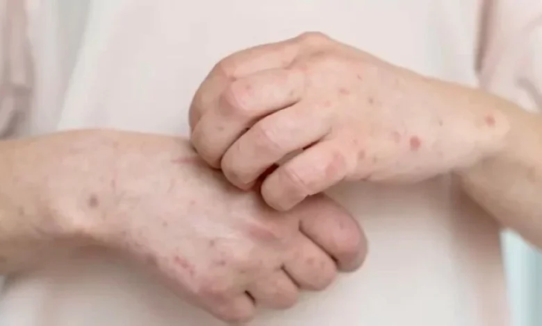 «الجذام» يضرب من جديد.. الكونغو تسجل أكثر من 140 إصابة جديدة