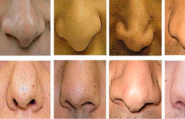 لماذا لا يوجد أنف مثالي يناسب الجميع؟...